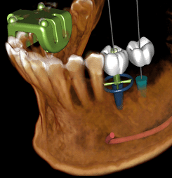 Dental Implants Animated