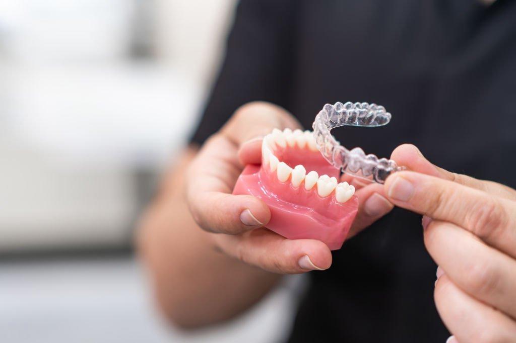 Dental professional demonstrating clear aligners on teeth model
