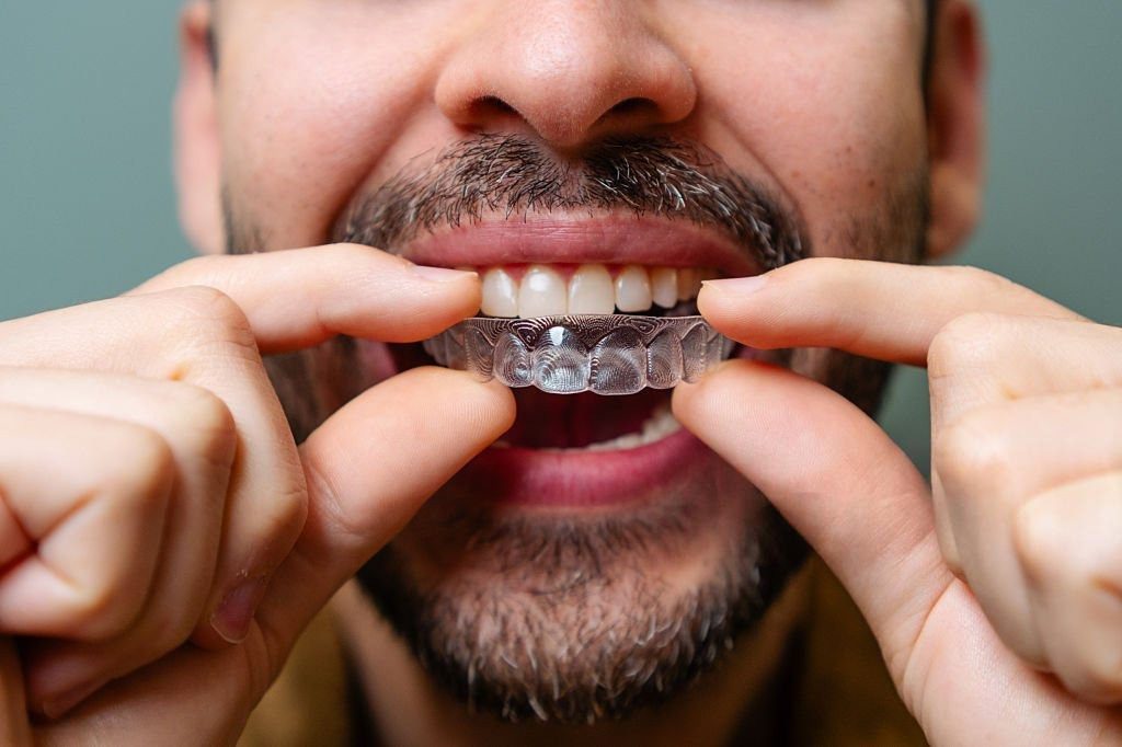 Man placing clear aligners on teeth during Invisalign treatment