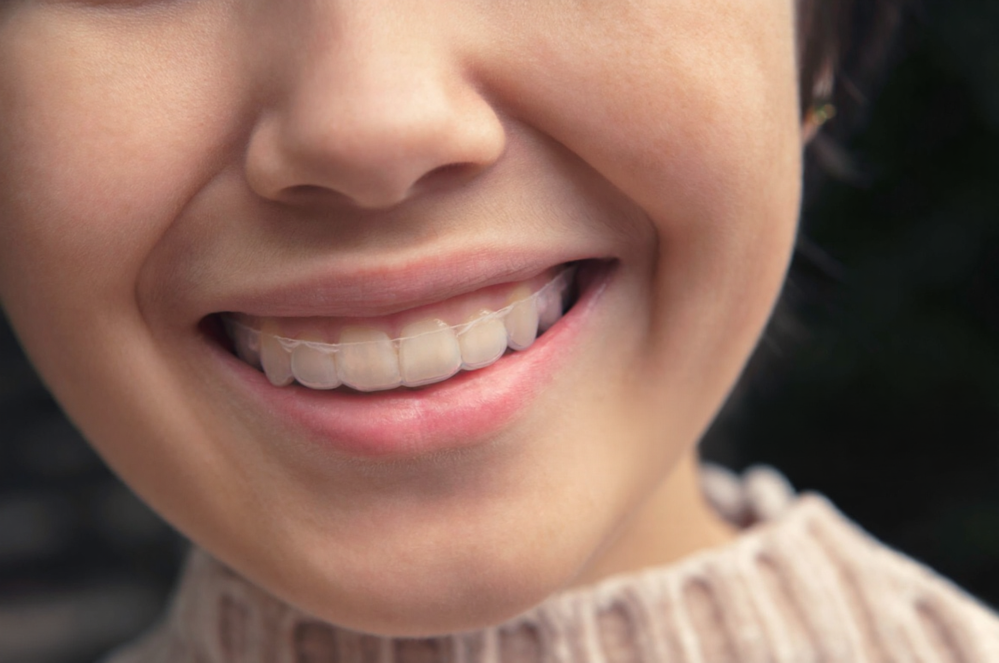 Close-up of adult smile wearing Invisalign clear aligners