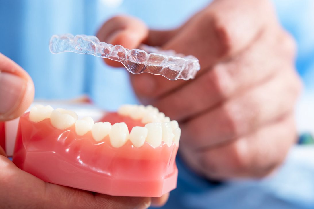 Clear Invisalign aligner being placed on dental model showing how aligners fit over teeth