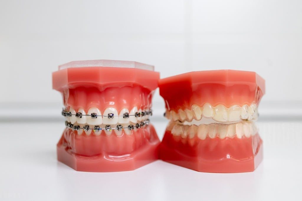 Comparison of traditional braces and clear aligners on dental model