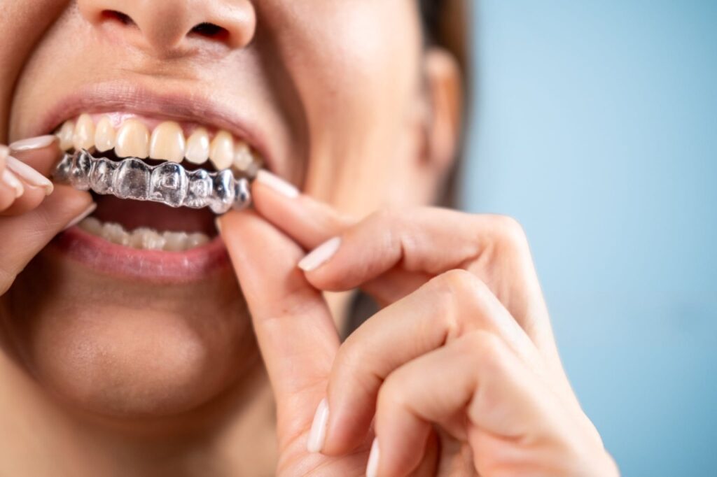 Woman putting in Invisalign clear aligners during teeth straightening treatment